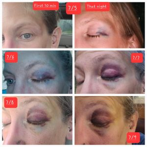 6 images showing the progression of Cyndi's black eye over the course of 4 days, getting worse each day.