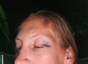 Cyndi's eye a few hours after she gave herself a black eye