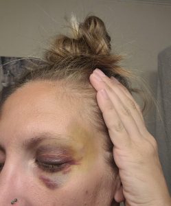 the worst the black eye got before it started to look better.